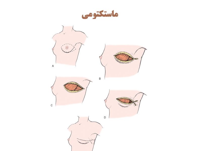 ماستکتومی