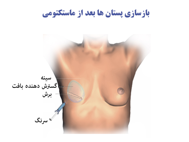 بازسازی پستان ها بعد از ماستکتومی
