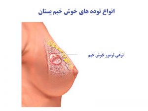 انواع توده های خوش خیم پستان