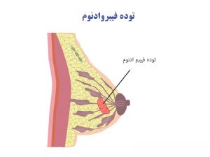 توده فیبروادنوم