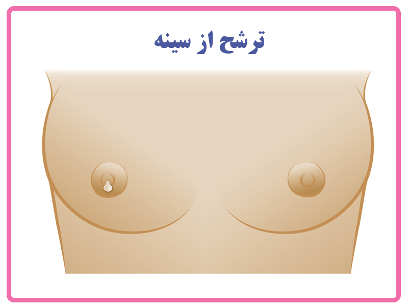 ترشح از سینه