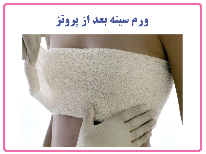 ورم سینه بعد از پروتز