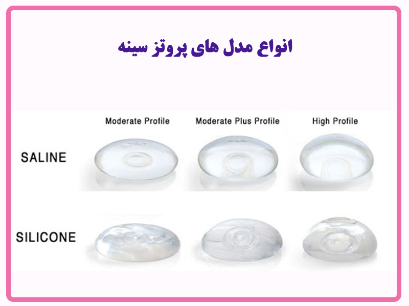 انواع مدل های پروتز سینه