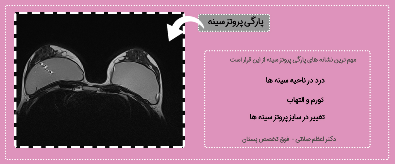 علائم پارگی پروتز سینه