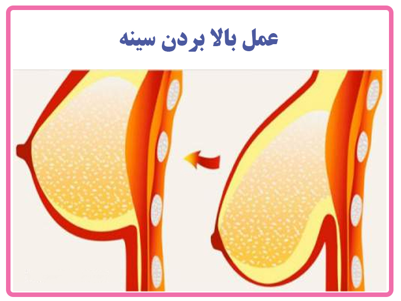 عمل بالا بردن سینه