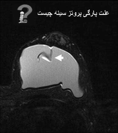 علت پارگی پروتز سینه