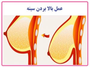 عمل بالا بردن سینه