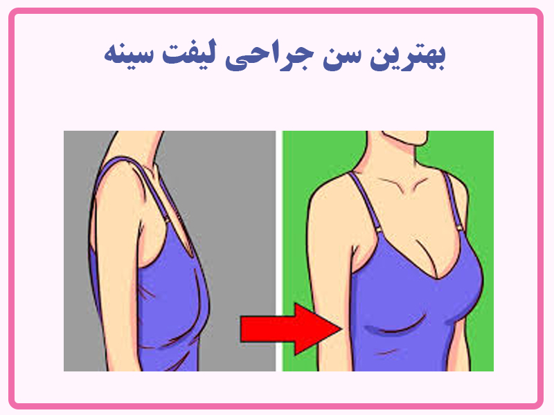 بهترین سن جراحی لیفت سینه