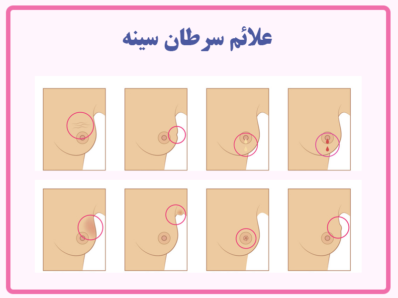 عکس علائم سرطان سینه در زنان