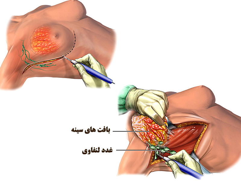 جراحی تخلیه پستان