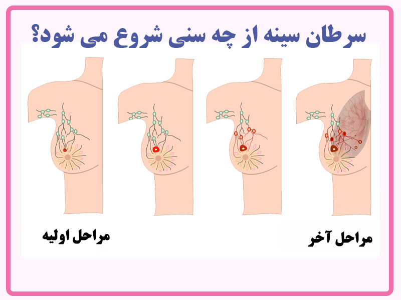 سن شروع سرطان سینه