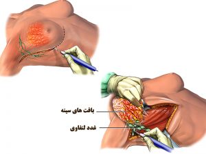 جراحی تخلیه پستان