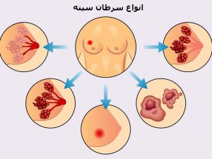 انواع سرطان سینه