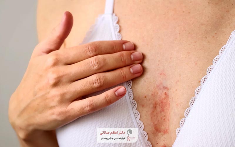 عوامل بروز سرطان نوک سینه در زنان