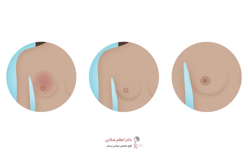 پیشگیری از سرطان نوک سینه