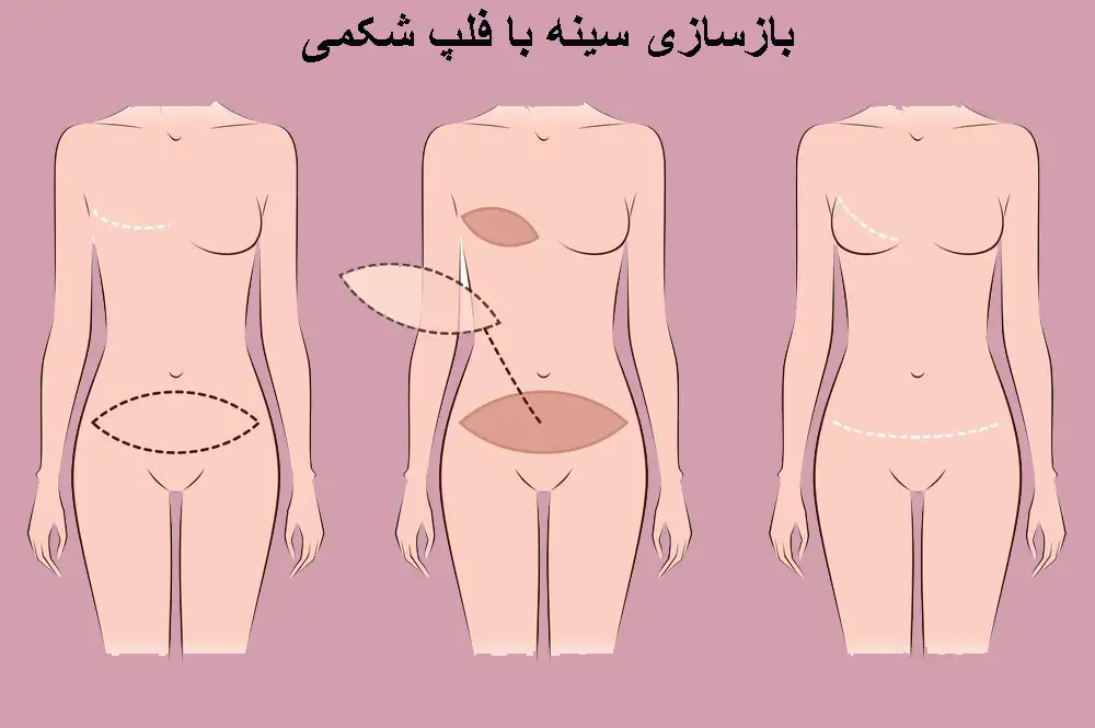 بازسازی با فلپ شکمی