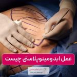 عمل ابدومینوپلاستی چیست + قیمت و هزینه جراحی زیبایی شکم ابدو