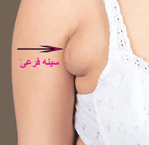سینه فرعی در بدن