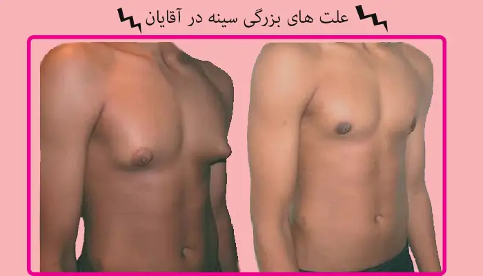 علت های بزرگی سینه در اقایان