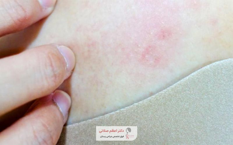 آیا سرطان سینه خطرناک و کشنده است؟ تغییر رنگ پوست در سرطان پستان