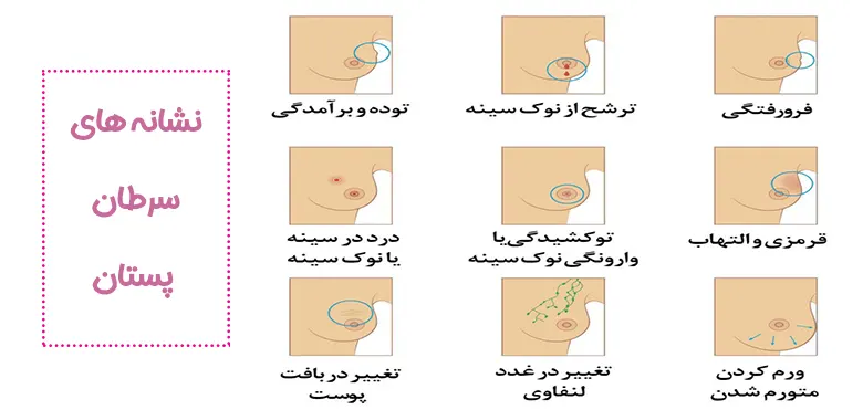 نشانه های سرطان پستان