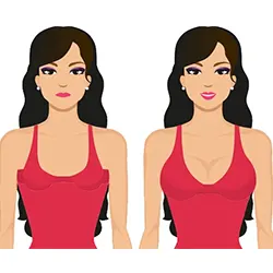 دختر دارای پروتز سینه
