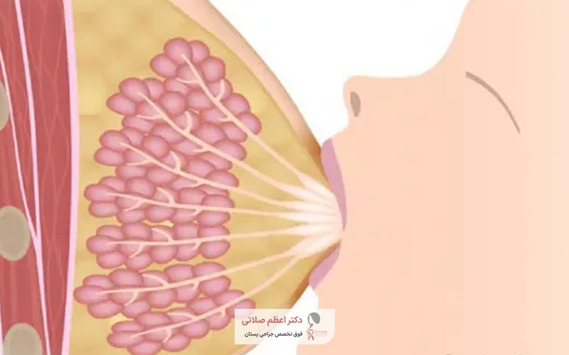 یکی از علت‌های عفونت قارچی سینه و پستان در زنان شیر دادن به فرزند است