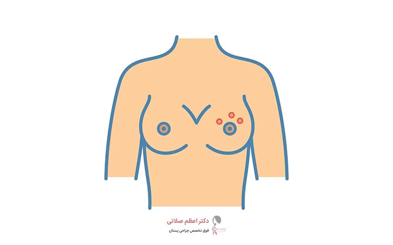 عفونت قارچی پستان و سینه در زنان چیست و چه علائمی دارد