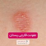 عفونت قارچی پستان و سینه در زنان + نکات، علائم و درمان آن در خانه