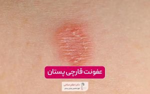 عفونت قارچی پستان و سینه در زنان + نکات، علائم و درمان آن در خانه