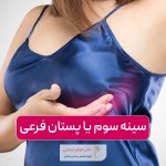 سینه سوم یا پستان فرعی چیست؟ علت پدیدار شدن آن در زنان