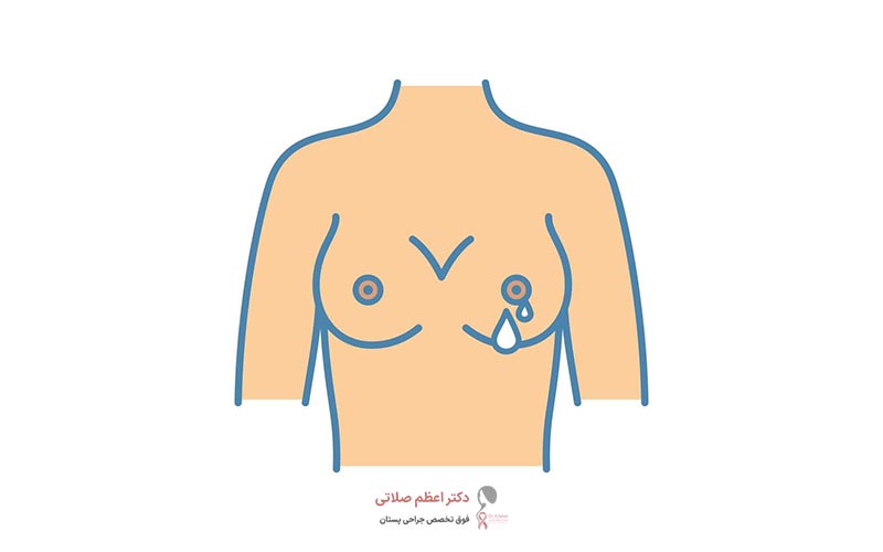 ترشح آبکی از نوک سینه زنان