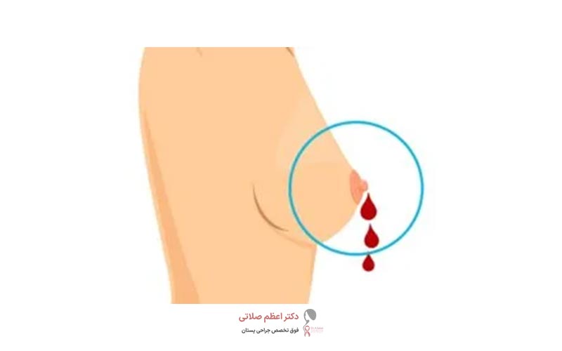 ترشحات خونی و صورتی از پستان زنان چیست