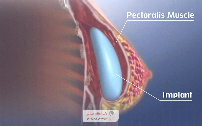 نحوه انجام عمل همزمان ماموپلاستی افزایشی با ماستوپکسی