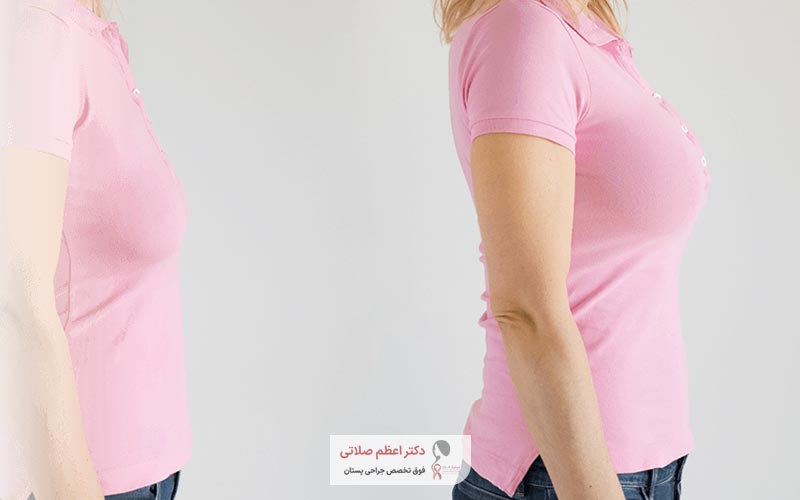 چه افرادی برای لیفت سینه مناسب هستند + عکس قبل و بعد از جراحی بالاکشیدن پستان