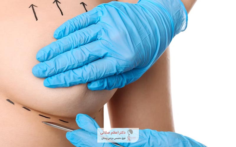 قیمت و هزینه عمل لیفت سینه در سال ۱۴۰۴ در تهران چقدر است