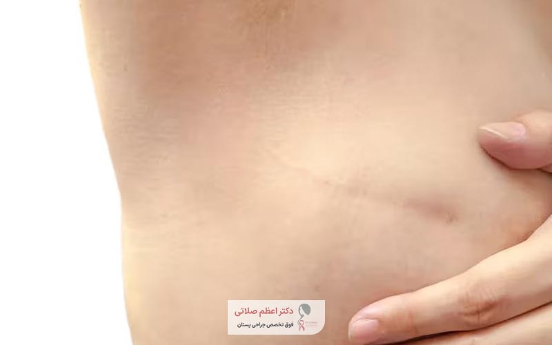 مدت زمان دوران نقاهت عمل ماستکتومی یا تخلیه پستان چقدر است
