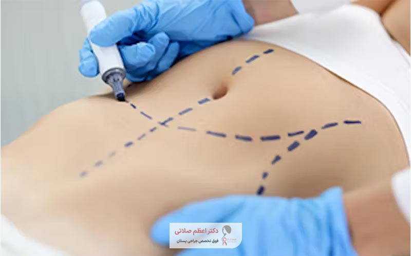 مقایسه عمل ابدومینوپلاستی با پیکرتراشی و لیپوساکشن
