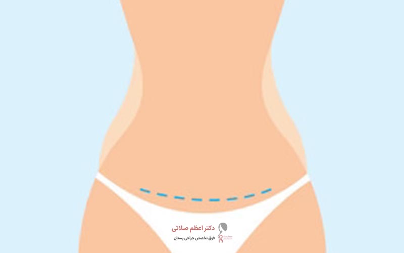 عوارض مینی ابدومینوپلاستی یا مینی ابدو (مینی لیفت شکم) چیست