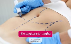 عوارض ابدومینوپلاستی و جراحی زیبایی شکم در زنان و مردان