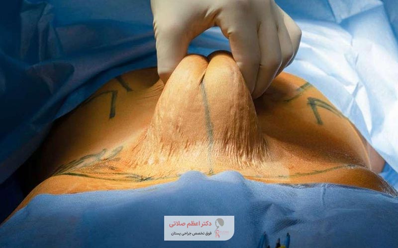 مرگ بر اثر ابدومینوپلاستی و جراحی زیبایی شکم در حدود 0.02 درصد است