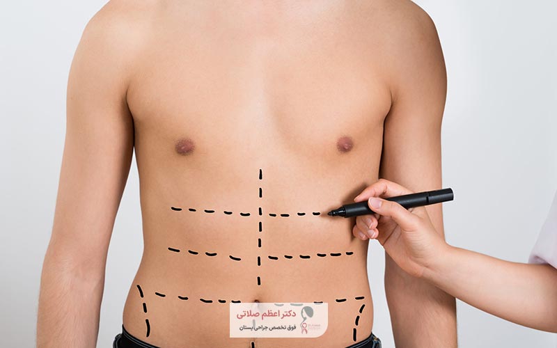 آیا عمل جراحی ابدومینوپلاستی خطرناک است؟