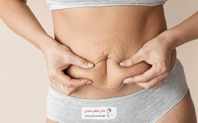 ماندگاری ابدومینوپلاستی و جراحی زیبایی شکم چقدر است