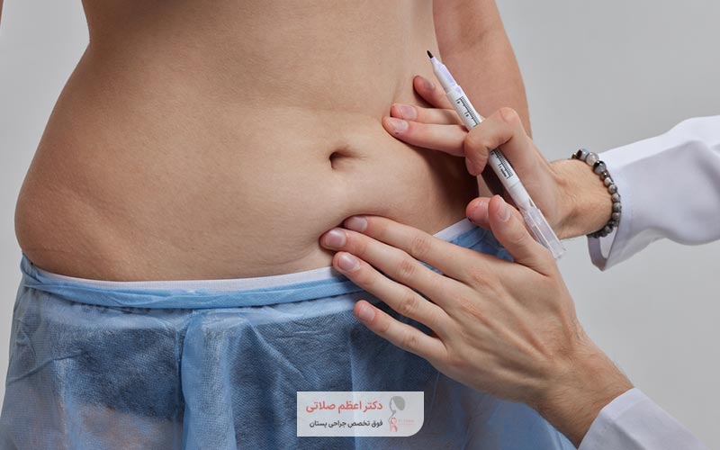 هرینه های جانبی عمل زیبایی شکم و ابدو چیست