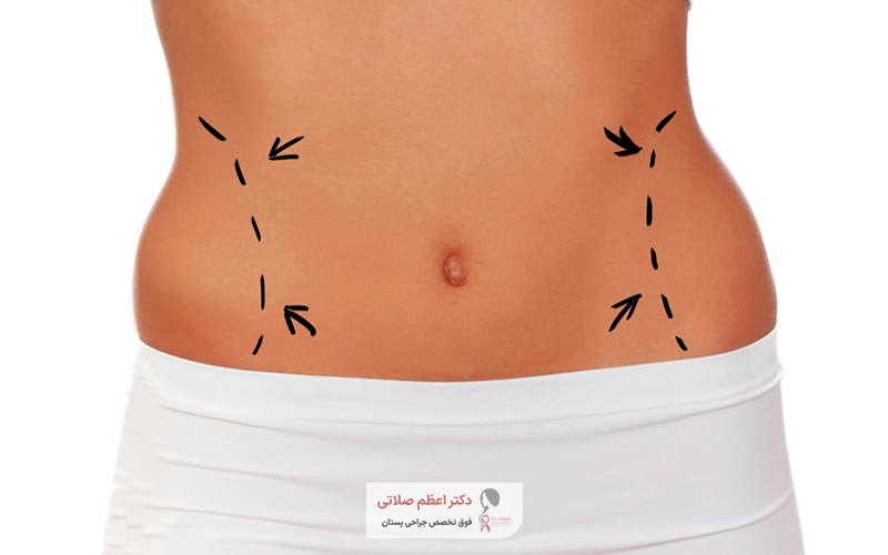 عوامل موثر بر افزایش قیمت عمل ابدومینوپلاستی زنان و مردان چیست
