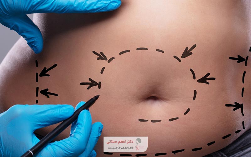 ویژگی های بهترین جراح ابدومینوپلاستی در تهران منطقه سعادت آباد و بلوار کشاورز کیست