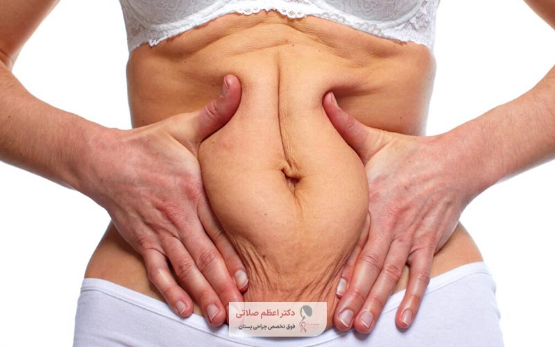 تغذیه و رژیم غذایی مناسب یکی از مهمترین مراقبت های بعد از ابدومینوپلاستی است