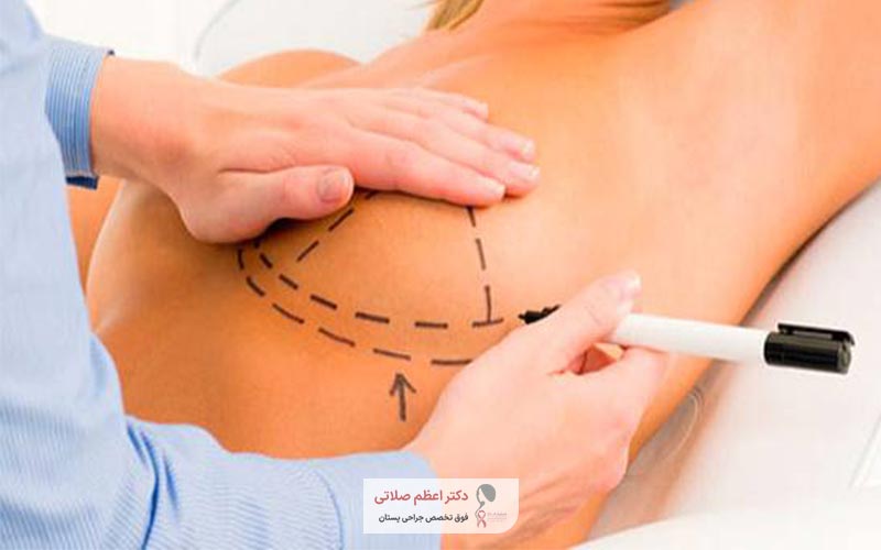 مراحل جراحی کوچک کردن سینه در زنان چگونه است و چگونه انجام می شود