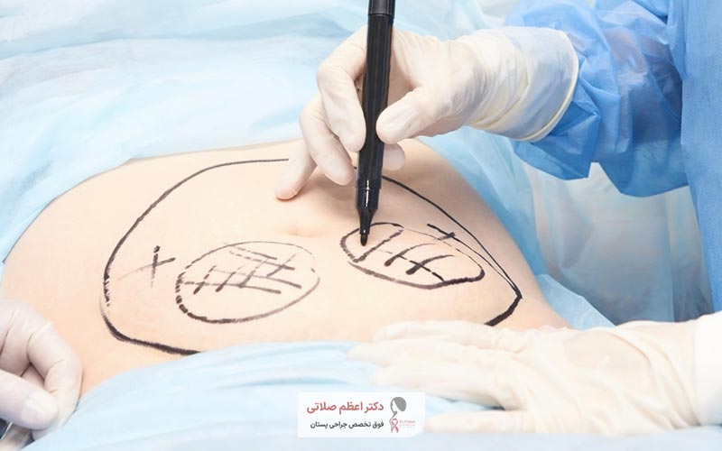 ویژگی های بهترین جراح زیبایی شکم و دکتر عمل ابدو چیست