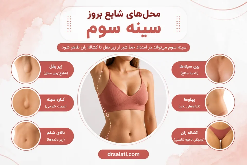 محل هایی که بیشترین احتمال بروز سینه سوم و پستان فرعی را دارند کدامند